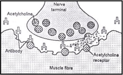 Diagram of a neuromuscular junction in people with myasthenia gravis